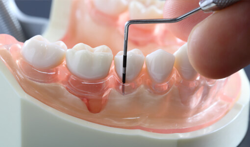 歯周病治療・歯周外科
